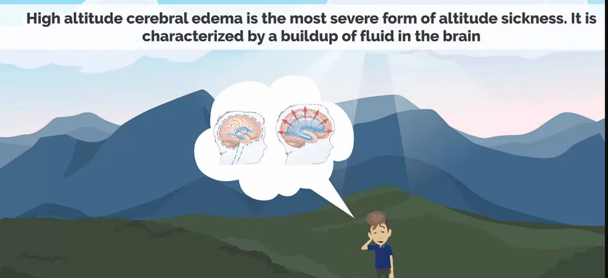 High Altitude Cerebral edema