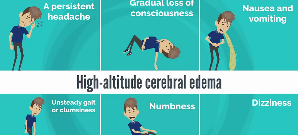 Symptoms of Altitude Sickness(High altitude cerebral edema)